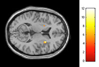 fMRI tests revealed increased activity in right insula, the part of the brain that regulates satiety and cravings, after participants consumed walnuts. Credit: Beth Israel Deaconess Medical Center
