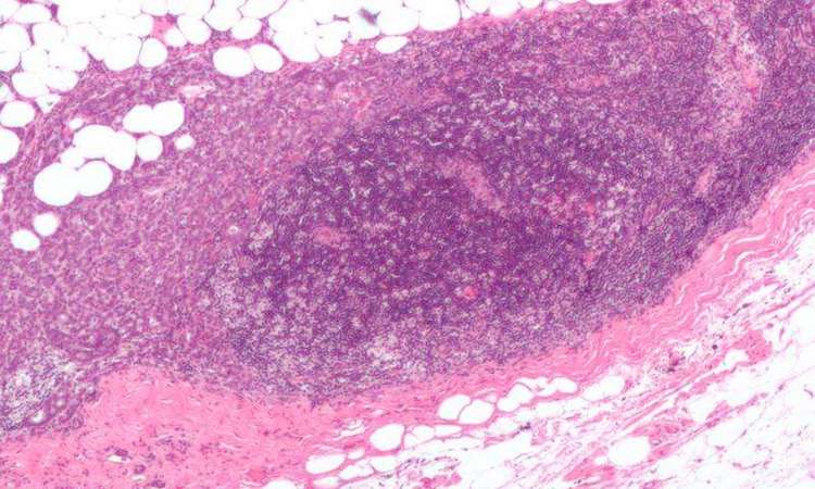 Micrograph showing a lymph node invaded by ductal breast carcinoma, with extension of the tumour beyond the lymph node. Credit: Nephron/Wikipedia