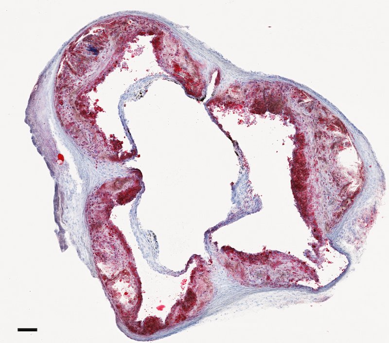Cross section of an aorta from a mouse that was fed a high-fat, high-cholesterol diet, which accelerates the build-up of plaque. The large red plaque on the inside of the aorta was labeled with oil based stain, which highlights lipids. Credit: Dr. Dalia Gaddis, La Jolla Institute for Allergy and Immunology