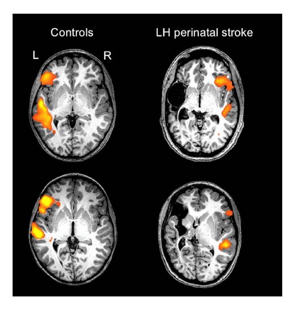 Individual scans of two healthy controls and two individuals with a left-hemisphere (LH) perinatal stroke. The orange/yellow activation shows the normal language areas of the left hemisphere in healthy individuals, as compared with the reorganized language areas in individuals with a left-hemisphere perinatal stroke. Credit: Elissa Newport
