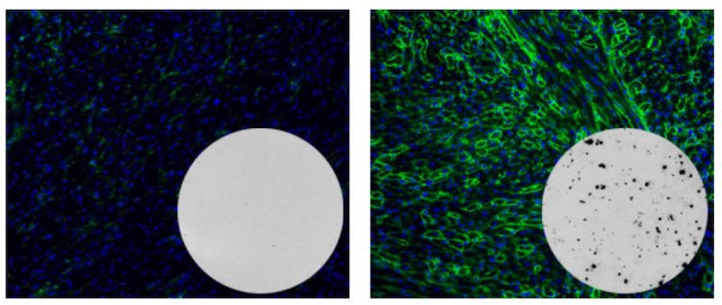 1These images highlight the stark contrast between mouse models of untreated Duchenne muscular dystrophy (left) and those treated with a CRISPR-based genetic therapy after one year (right). On the right, green indicates a higher level of dystrophin gene expression. The dark spots in the inset show T cells from these mice responding to the bacterial Cas9 protein, indicating the presence of an immune response to the therapy. Credit: Charles Gersbach, Duke University