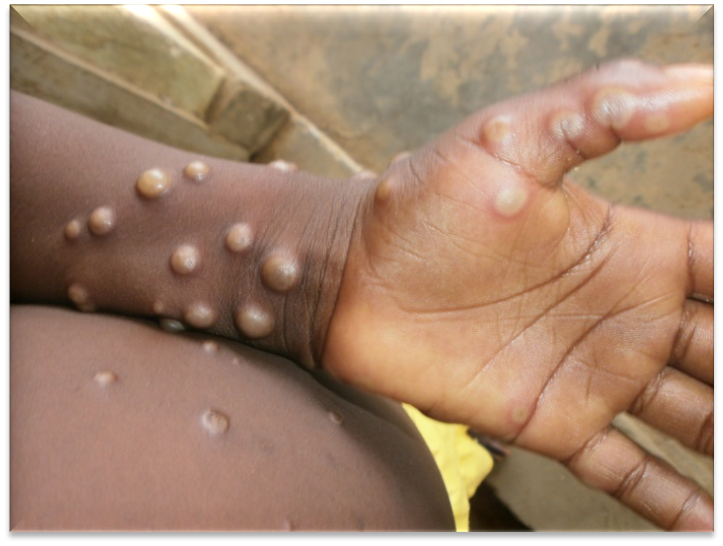 Photo credit: Nigeria Centre for Disease Control