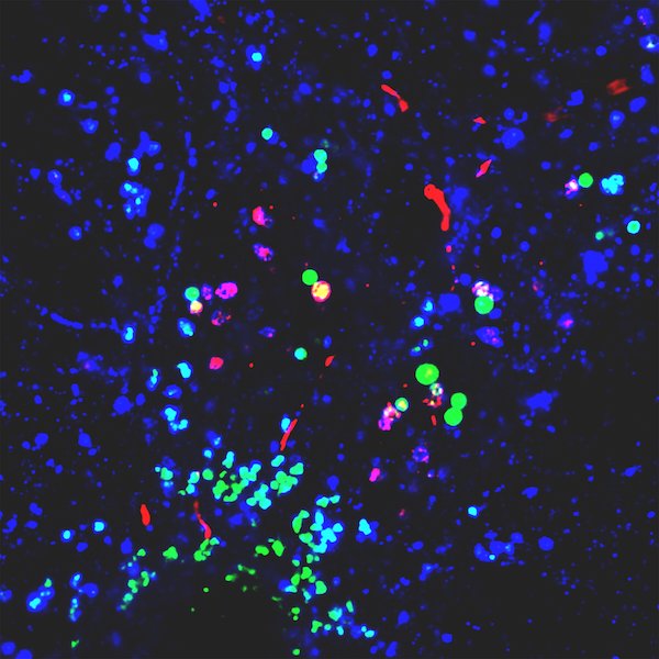 Plastic nanoparticles (green), visible under a microscope, co-mingling with protein aggregates(red) in neuronal lysosomes (blue). Typically, concentrations of the protein aggregates are so small, they would not be viable at this level. Credit: Duke Health